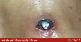 Thiếu niên gãy xương mũi do bi sắt, cảnh báo nguy cơ từ ná cao su