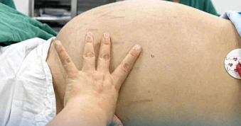 Thiếu nữ 19 tuổi tưởng béo bụng, bác sĩ hút 10 lít dịch từ khối u khổng lồ
