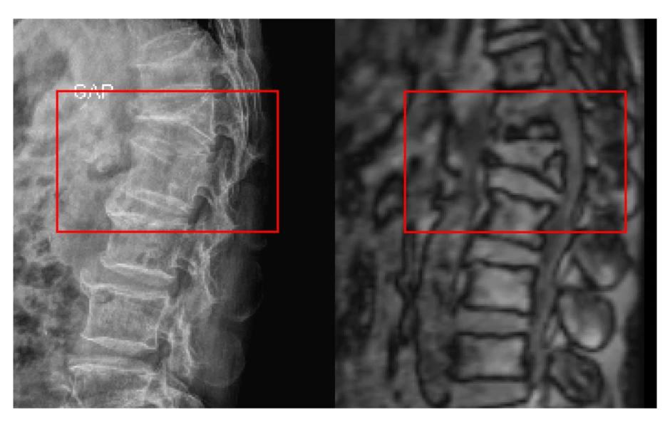 Thoát cảnh ngồi xe lăn sau 3 ngày phẫu thuật cột sống Thoát cảnh ngồi xe lăn sau 3 ngày phẫu thuật cột sống