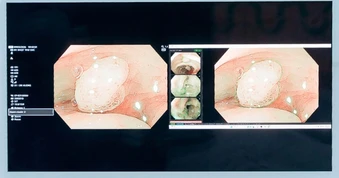 Thời điểm phát hiện ung thư đại trực tràng quyết định tiên lượng điều trị