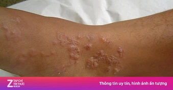 Thói quen xấu khiến thanh niên nhiễm cùng lúc 3 loại ký sinh trùng