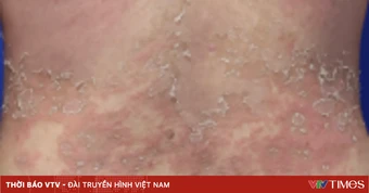 Thuốc sinh học mới giúp kiểm soát vảy nến thể mủ