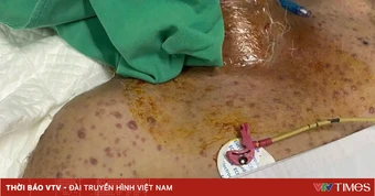 Thủy đậu có thể đe doạ tính mạng nếu biến chứng nặng
