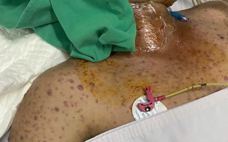 Thủy đậu có thể đe doạ tính mạng nếu biến chứng nặng Thủy đậu có thể đe doạ tính mạng nếu biến chứng nặng