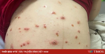 Thủy đậu khi mang thai: Nguy cơ cho cả mẹ và thai nhi