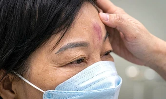 Tiêm filler sai có thể mù mắt vĩnh viễn sau vài phút