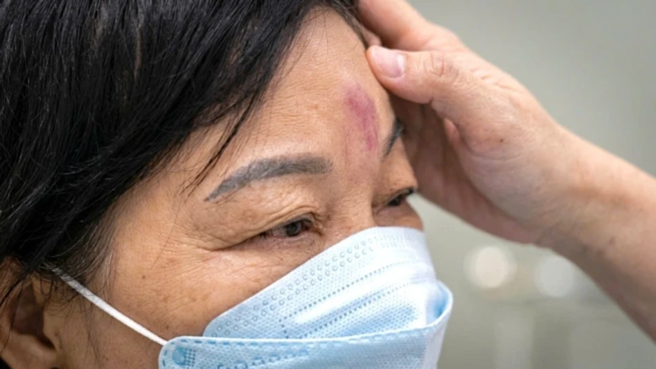 Tiêm filler sai có thể mù mắt vĩnh viễn sau vài phút Tiêm filler sai có thể mù mắt vĩnh viễn sau vài phút