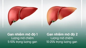 Tiến trình gan nhiễm mỡ - Báo TinVina