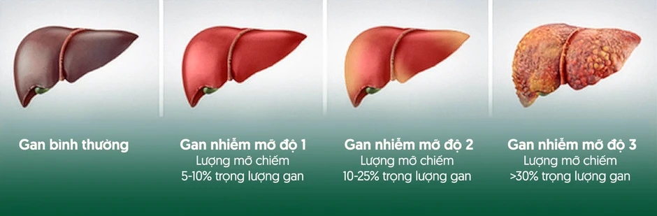 Tiến trình gan nhiễm mỡ - Báo TinVina Tiến trình gan nhiễm mỡ - Báo TinVina