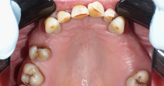 Tiêu xương răng: Hậu quả và cách điều trị