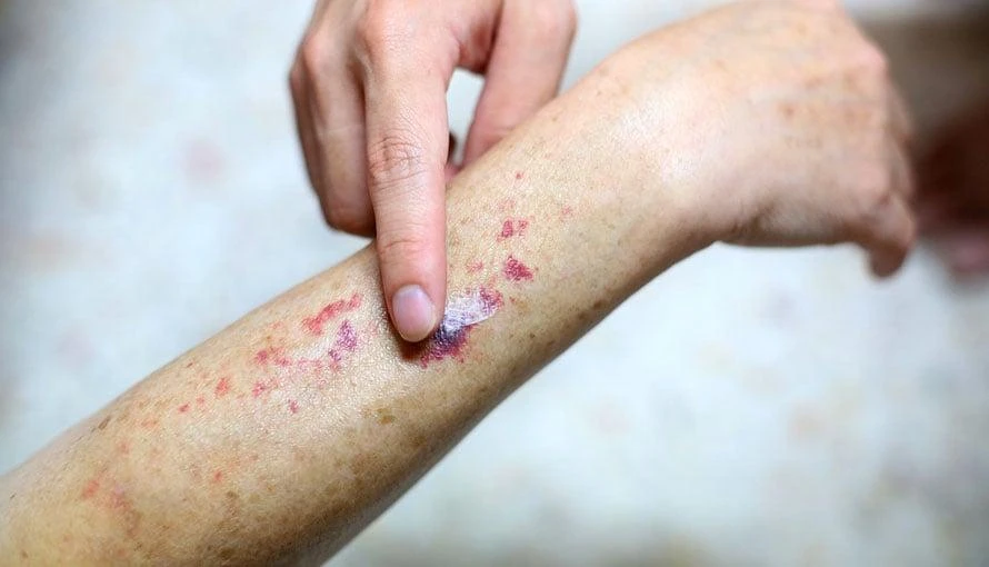 TikToker Đan Thy bị ung thư máu: Hối hận vì duy trì 4 thói quen sống thiếu lành mạnh, nhiều người trẻ cũng đang làm TikToker Đan Thy bị ung thư máu: Hối hận vì duy trì 4 thói quen sống thiếu lành mạnh, nhiều người trẻ cũng đang làm