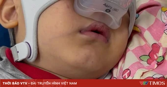 Tím tái khi ngủ, bé trai 4 tuổi phát hiện giảm thông khí do béo phì