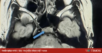 Tổn thương vùng thân não do mắc tay chân miệng