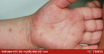 TP Hồ Chí Minh: Số ca mắc tay chân miệng tăng mạnh