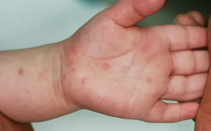 TP Hồ Chí Minh: Số ca mắc tay chân miệng tăng mạnh TP Hồ Chí Minh: Số ca mắc tay chân miệng tăng mạnh