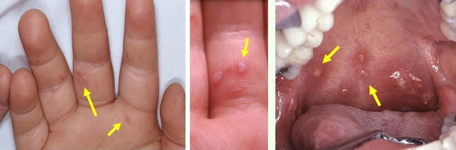 TP.HCM: Biến thể mới gây tay chân miệng nguy hiểm thế nào?