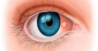 TPHCM: Cấp cứu người đàn ông suýt mù vì một... "mộng thịt"