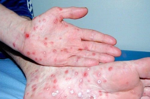 TPHCM: Số người mắc bệnh giang mai tăng đột biến TPHCM: Số người mắc bệnh giang mai tăng đột biến
