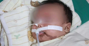 Trẻ 1 tháng tuổi cấp cứu sau khi người thân nhỏ nhầm axit vào miệng