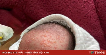 Trẻ sơ sinh mắc thủy đậu suy hô hấp nặng