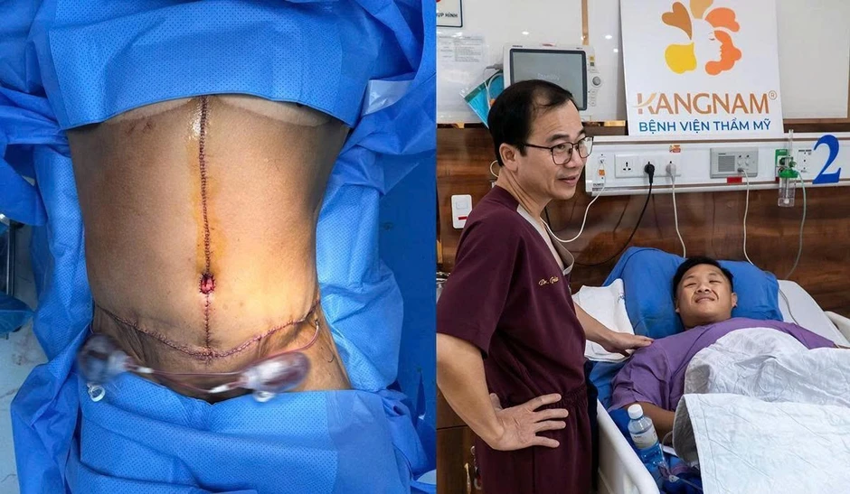 Trọng Nhân trải qua ca phẫu thuật cắt da lần thứ 3 với miếng da khổng lồ 8.1kg Trọng Nhân trải qua ca phẫu thuật cắt da lần thứ 3 với miếng da khổng lồ 8.1kg