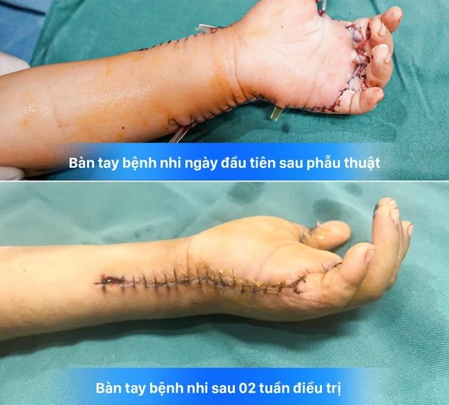 Tự bật máy bào quế, bé trai 7 tuổi suýt mất bàn tay Tự bật máy bào quế, bé trai 7 tuổi suýt mất bàn tay
