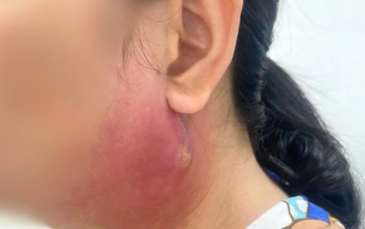 Từ nốt mụn nhỏ vùng mông, nam thanh niên 17 tuổi suy đa tạng nguy kịch Từ nốt mụn nhỏ vùng mông, nam thanh niên 17 tuổi suy đa tạng nguy kịch