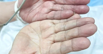 Tự ý bỏ thuốc điều trị quan trọng, người phụ nữ tắc mạch nguy kịch