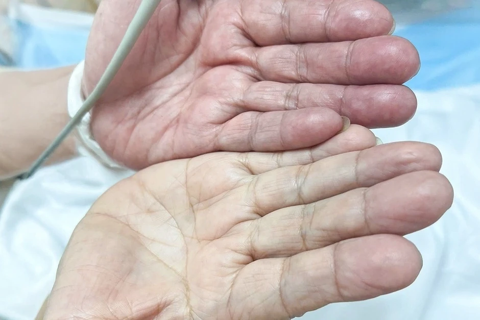 Tự ý bỏ thuốc điều trị quan trọng, người phụ nữ tắc mạch nguy kịch Tự ý bỏ thuốc điều trị quan trọng, người phụ nữ tắc mạch nguy kịch