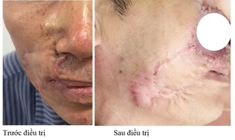 Ung thư biểu mô tế bào đáy tái phát liên tiếp, lời cảnh báo từ bác sĩ