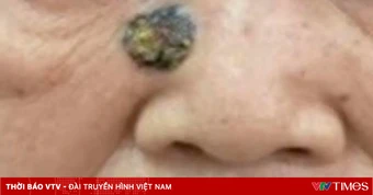 Ung thư da tiến triển âm thầm từ tổn thương nhỏ
