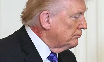 Vết đỏ lạ trên cổ ông Trump gây chú ý