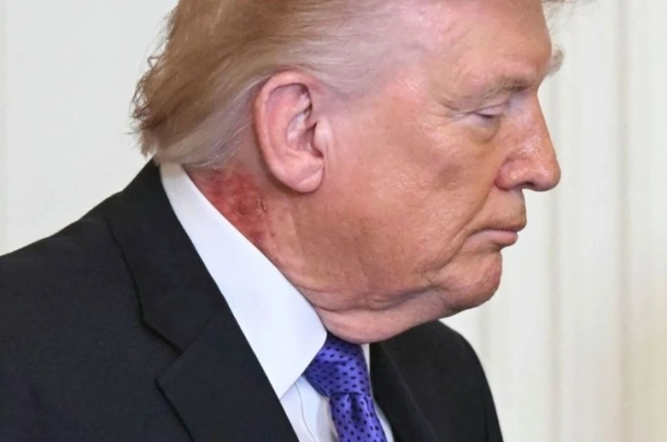 Vết đỏ lạ trên cổ ông Trump gây chú ý Vết đỏ lạ trên cổ ông Trump gây chú ý