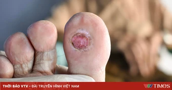 Vết loét lâu liền ở bàn chân có thể là dấu hiệu bệnh động mạch chi dưới