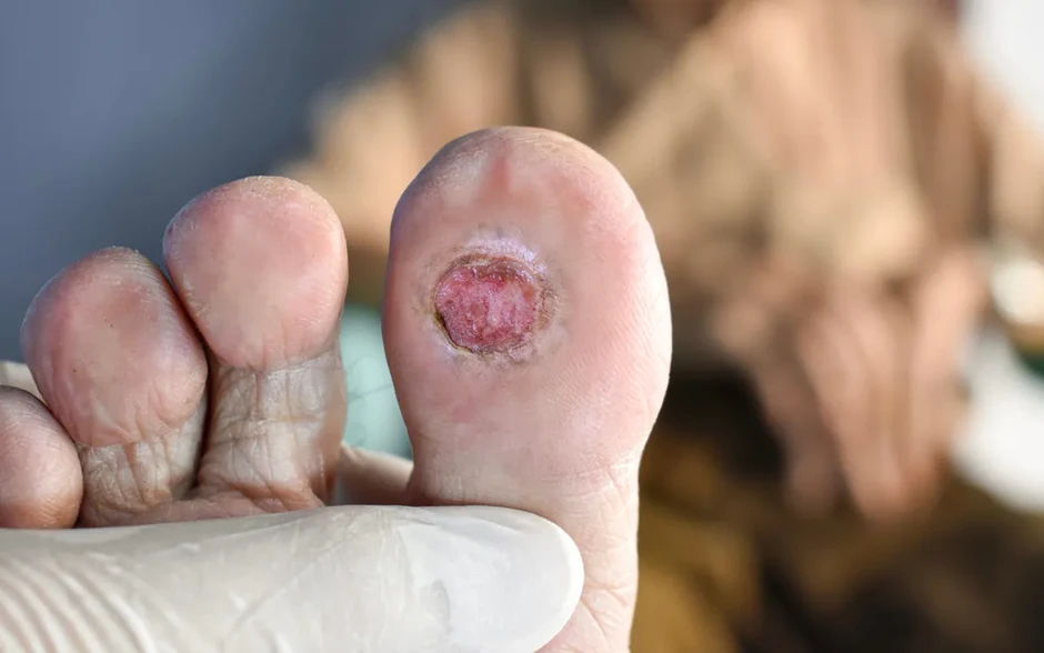 Vết loét lâu liền ở bàn chân có thể là dấu hiệu bệnh động mạch chi dưới Vết loét lâu liền ở bàn chân có thể là dấu hiệu bệnh động mạch chi dưới