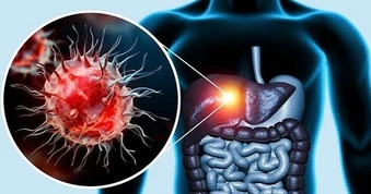 Vì sao không uống rượu bia vẫn có thể mắc viêm gan?