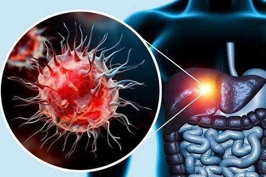 Vì sao không uống rượu bia vẫn có thể mắc viêm gan? Vì sao không uống rượu bia vẫn có thể mắc viêm gan?