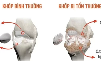 Vì sao khớp đau, cứng hơn trong mùa nóng? - Báo TinVina