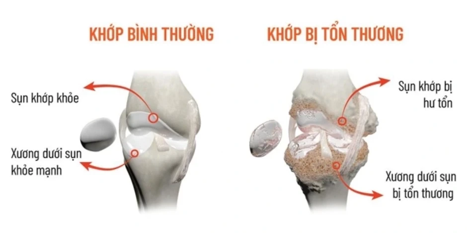 Vì sao khớp đau, cứng hơn trong mùa nóng? - Báo TinVina