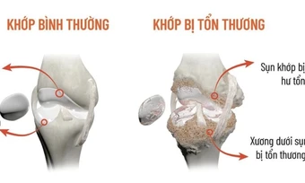 Vì sao khớp kêu lạo xạo? - Báo TinVina