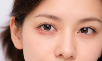 Vì sao mí mắt xuất hiện nốt sưng? - Báo TinVina