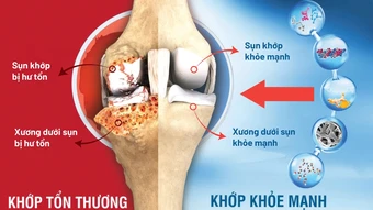 Vì sao thời tiết thay đổi lại đau khớp? - Báo TinVina