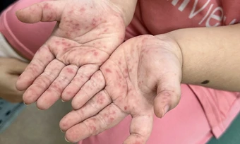 Vì sao trẻ tái mắc tay chân miệng nhiều lần? - Báo TinVina