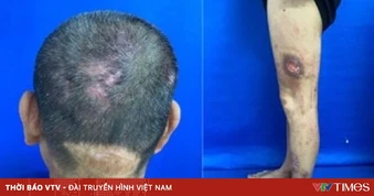 Viêm da tự tạo: Khi tổn thương da bắt nguồn từ rối loạn tâm lý