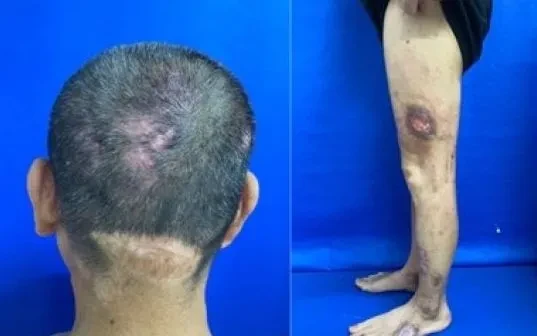 Viêm da tự tạo: Khi tổn thương da bắt nguồn từ rối loạn tâm lý Viêm da tự tạo: Khi tổn thương da bắt nguồn từ rối loạn tâm lý