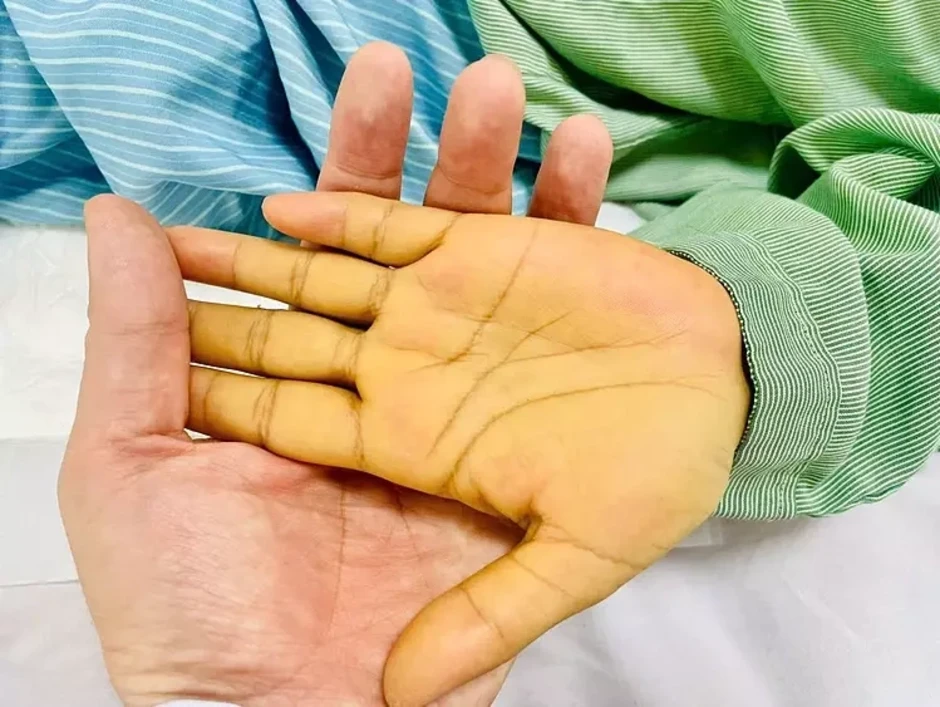Viêm gan A, B, C, D, E lây nhiễm và hại cơ thể thế nào Viêm gan A, B, C, D, E lây nhiễm và hại cơ thể thế nào