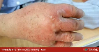 Viêm mô bào: Đừng chủ quan với những vết sưng đỏ trên da