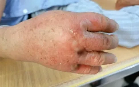 Viêm mô bào: Đừng chủ quan với những vết sưng đỏ trên da
