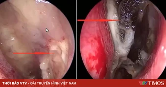 Viêm mũi xoang do nấm xâm nhập: Bệnh hiếm nhưng có thể đe dọa tính mạng