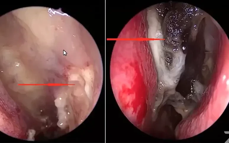 Viêm mũi xoang do nấm xâm nhập: Bệnh hiếm nhưng có thể đe dọa tính mạng Viêm mũi xoang do nấm xâm nhập: Bệnh hiếm nhưng có thể đe dọa tính mạng